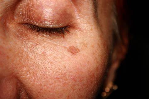 UNEVEN SKIN TONE & PIGMENTATION