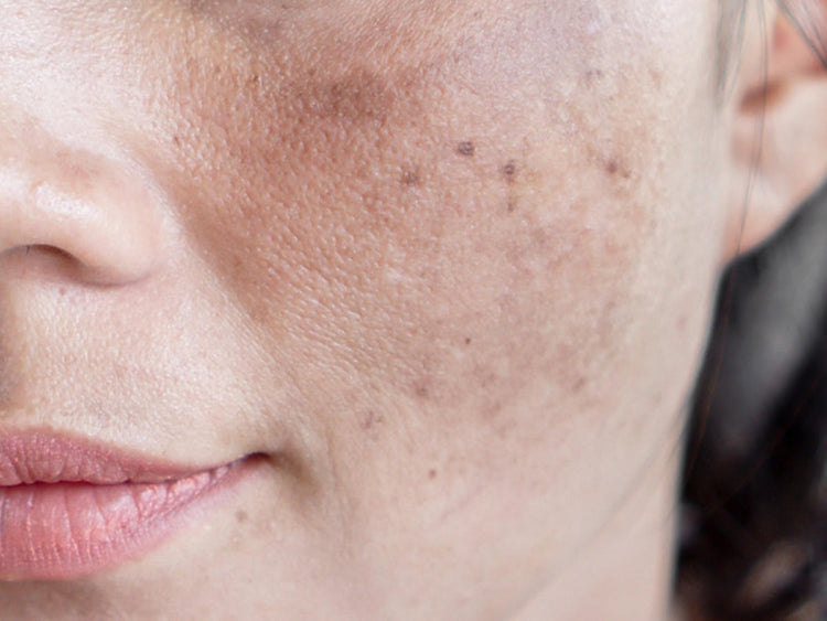CONGESTED & OILY SKIN